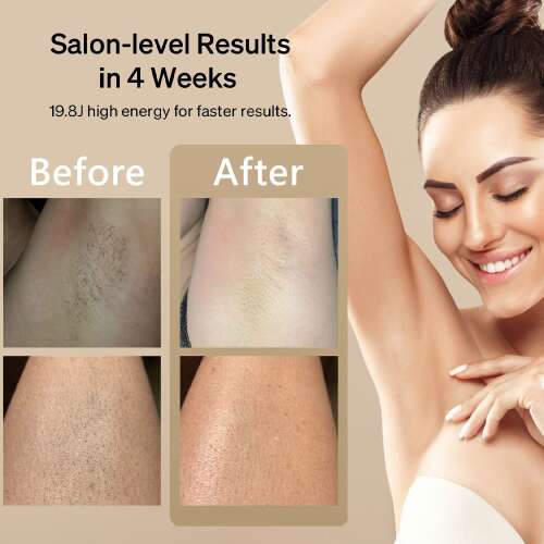 Dollcini IPL Lézeres Szőrtelenítő – Jéghideg Technológia, Teljes Testre